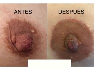 Aumento mamas - Dr. Agustín Matia