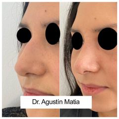 Rinoplastia - Dr. Agustín Matia