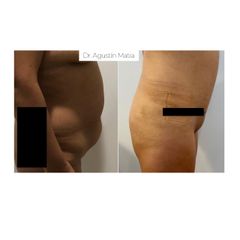Abdominoplastia - Dr. Agustín Matia