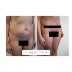 Abdominoplastia - Dr. Agustín Matia