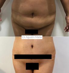 Abdominoplastia - Dr. Agustín Matia