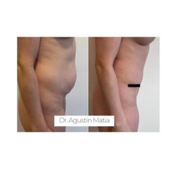 Abdominoplastia - Dr. Agustín Matia