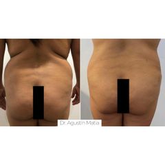 Liposucción - Dr. Agustín Matia