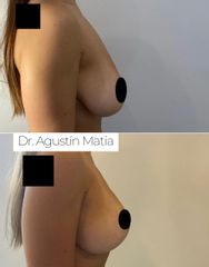 Aumento mamas - Dr. Agustín Matia