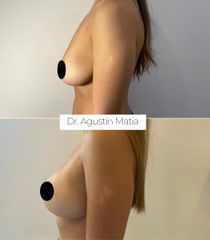 Aumento mamas - Dr. Agustín Matia