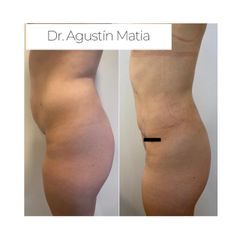 Abdominoplastia - Dr. Agustín Matia