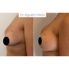 Aumento mamas - Dr. Agustín Matia