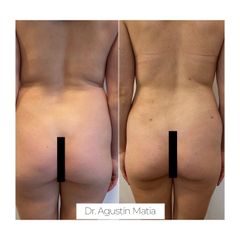 Liposucción - Dr. Agustín Matia