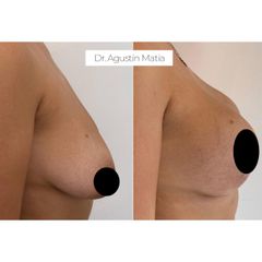 Aumento mamas - Dr. Agustín Matia