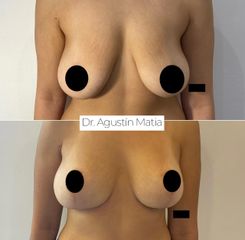 Mastopexia - Dr. Agustín Matia