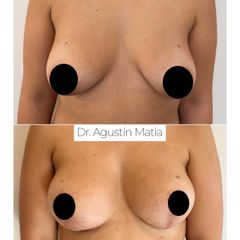 Mastopexia - Dr. Agustín Matia