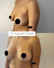 Mastopexia - Dr. Agustín Matia