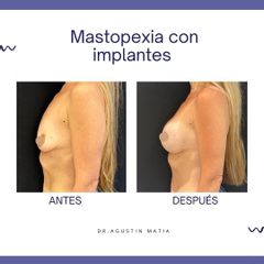 Mastopexia - Dr. Agustín Matia