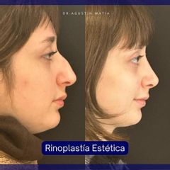Rinoplastia - Dr. Agustín Matia
