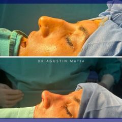 Rinoplastia - Dr. Agustín Matia