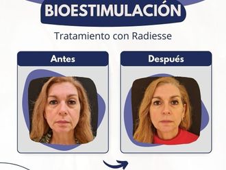 Rejuvenecimiento facial antes y después - 869417