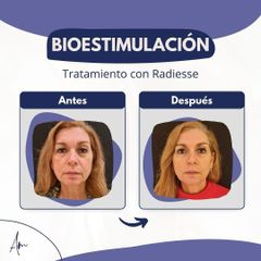 Bioestimulación - Dr. Agustín Matia