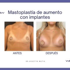 Aumento mamas - Dr. Agustín Matia