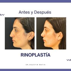 Rinoplastia - Dr. Agustín Matia