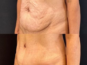 Abdominoplastía antes y después - 871420