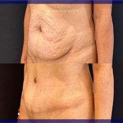 Abdominoplastia - Dr. Agustín Matia