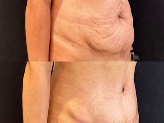 Abdominoplastía antes y después - 871421