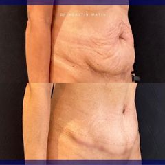 Abdominoplastia - Dr. Agustín Matia