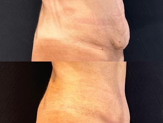 Abdominoplastía antes y después - 871422