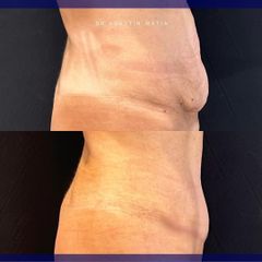 Abdominoplastia - Dr. Agustín Matia