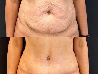 Abdominoplastía antes y después - 871423