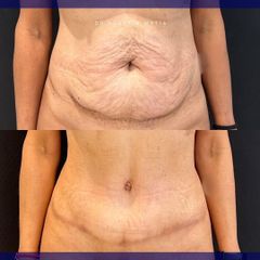 Abdominoplastia - Dr. Agustín Matia