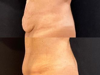 Abdominoplastía antes y después - 871424