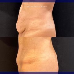 Abdominoplastia - Dr. Agustín Matia