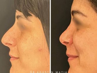 Rinoplastia antes y después - 871429