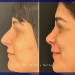 Rinoplastia - Dr. Agustín Matia