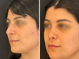 Rinoplastia antes y después - 871431