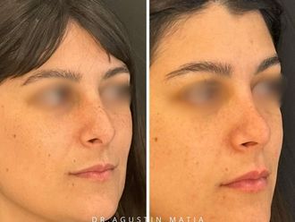 Rinoplastia antes y después - 871432