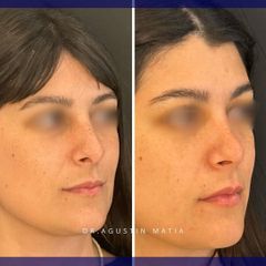 Rinoplastia - Dr. Agustín Matia