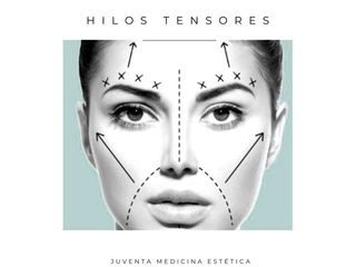 Hilos tensores