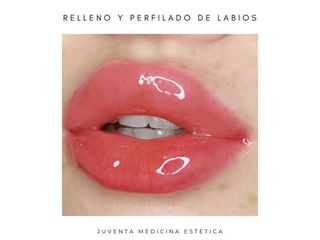 Relleno y perfilado de labios