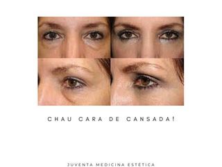 Estética Juventa - Rejuvenecimiento facial