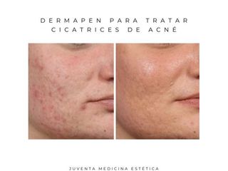 Estética Juventa - Cicatrices de acné