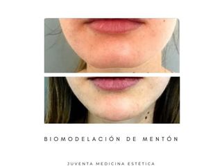 Estética Juventa - Biomodelación de mentón