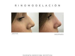 Estética Juventa - Rinomodelación