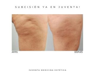 Tratamiento celulitis - Estética Juventa