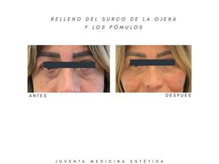 Rellenos faciales - Estética Juventa