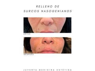 Relleno surcos nasogenianos - Estética Juventa