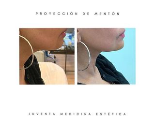 Proyección de mentón - Estética Juventa