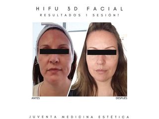 HIFU  - Estética Juventa