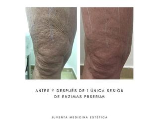 Tratamiento celulitis - Estética Juventa